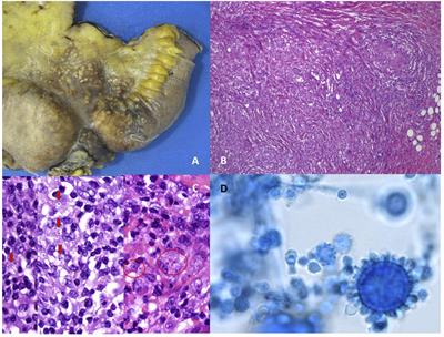 Timely Diagnosis of Histoplasmosis in Non-endemic Countries: A Laboratory Challenge